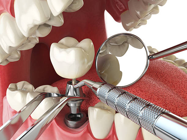 Best Emergency Dental Care for Broken or Chipped Teeth in Edgerton, KS